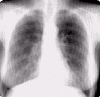 Обзорная рентгенограмма легких