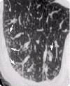 КТВР. Мелкоочаговые субплевральные структуры, симптом ветки вербы