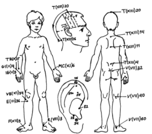 Основные зоны и точки, используемые для лечения спастической нижней диплегии при ДЦП