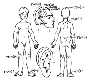 Основные зоны и точки, используемые для лечения спастической гемиплегии при ДЦП