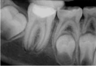 Дооперативная рентгенограмма незрелого первого моляра нижней челюсти с незавершенным апексогенезом. Пульпа сохранила жизнеспособность.