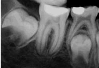 Благодаря наличию витальной пульпы стал возможным апексогенез после лечения кариозного поражения зуба. Если бы пульпа была некротизирована, апексофикация с гидроксидом кальция была бы единственным вариантом лечения, способствующим закрытию верхушечного отверстия.