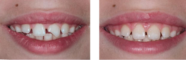Рис. 2. До лечения: улыбка, снимок без ретрактора (1:2). После лечения: улыбка, снимок без ретрактора (1:2).
