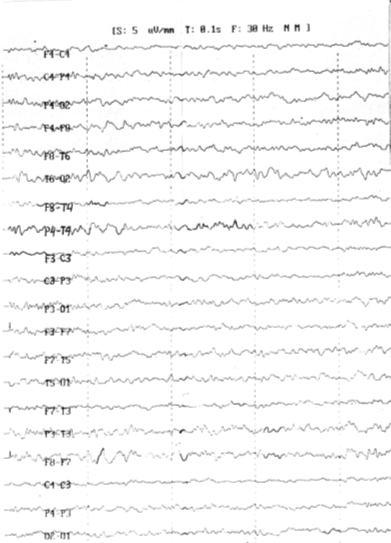 Рис. 11.1. ЭЭГ больного Д., 1966 г. рожд.: десинхронный (бета-1) тип ЭЭГ, при гипервентиляции регистрируются медленные волны дельта - тета диапазона в правой височно-теменной области.