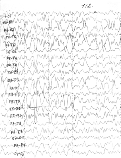 Рис. 11.2.: ЭЭГ дочери больного Д., 10 лет: на фоне признаков функциональной незрелости нейронов коры выявляется очаг эпилептической активности в левой теменно-височной области.