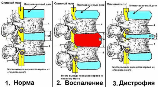 Схематическое изображение двух стадий остеохондроза: стадии воспаления и стадии дистрофии.
