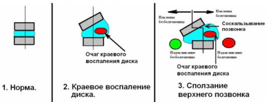 Механизм сползания позвонка с вершины клиновидного диска.
