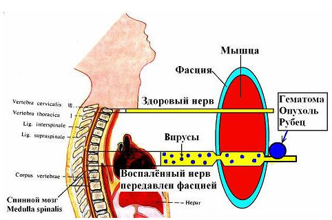 Причина возникновения радикулитов – туннельная невропатия воспалённых спинальных нервов (поражение нерва вирусом), гематома, опухоль, рубец.