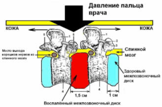 Диагностика остеохондроза.