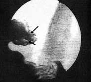Рентгенограмма через 5 лет после операции в положении Тренделенбурга на животе. Примечание. Гастроэзофагеальный рефлюкс отсутствует. Стрелками указан контур клапана.