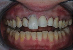Зуб №8 построен с микрогибридом на язычной и микрофилом на вестибулярной стороне и готов для предания формы
