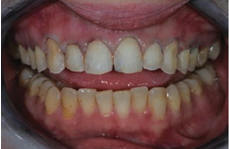 Консервативно отпрепарированные зубы №№ 4–13для прямых реставраций