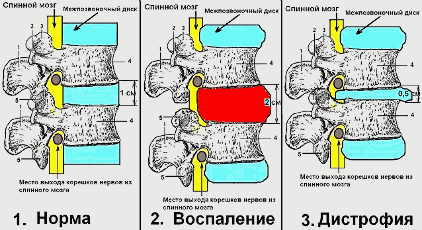 Схематическое изображение двух стадий остеохондроза: стадии воспаления и стадии дистрофии