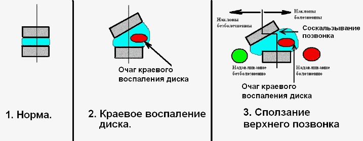 Механизм сползания позвонка с вершины клиновидного диска