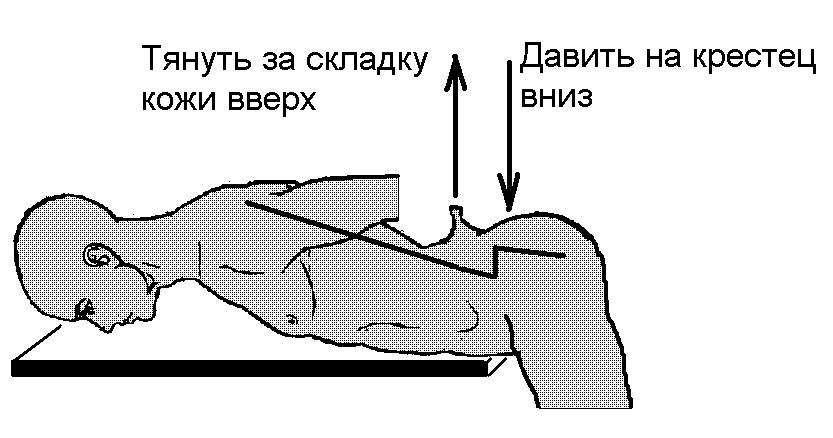 Позвоночник в зоне L.5 - S.1 искривляет свою ось в виде «лестницы»