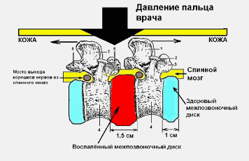Диагностика остеохондроза