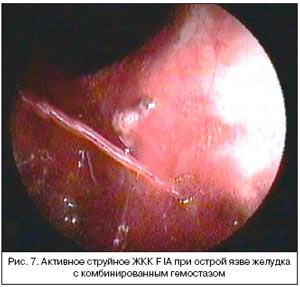 Рис. 7. Активное струйное ЖКТ F IIA при острой язве желудка с комбинированным гемостазом
