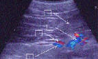 Цветовое допплеровское картирование устьевого отдела тестикулярной вены