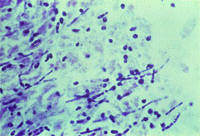  1.  .      Candida albicans    