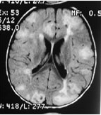 Рисунок 4. Магнитно-резонансное исследование головного мозга 