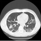 Рисунок 2. Больной М., 45 лет, идиопатическая интерстициальная пневмония (морфологический вариант — десквамативная интерстициальная пневмония). На КТ — «матовое стекло», фиброз 