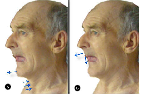 Рис. 2. Надевание нижней челюсти на верхнюю челюсть и наоборот