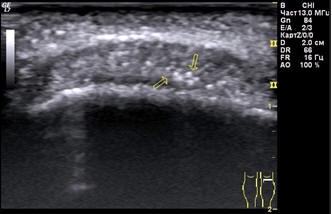 Рис. 2. Сонограмма тендокальциноза левого коленного сустава. Гиперэхогенные включения со слабо выраженной эхо-тенью в толще дистальной трети собственной связки надколенника слева.