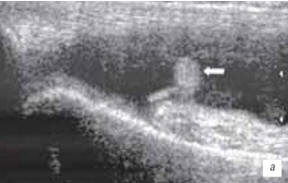 Рис. 3. Сонограмма выраженного синовита коленного сустава с наличием утолщенной, с краевыми разрастаниями синовиальной оболочки (стрелка) 