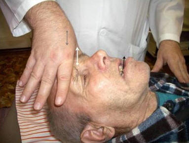 Рис. 25. Лёжа на спине, пациент приподнимает голову, преодолевая сопротивление руки врача, приложенной ко лбу, пытаясь высунуть язык