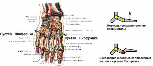Рисунок 1. Локализация сустава Лисфранка на правой стопе.