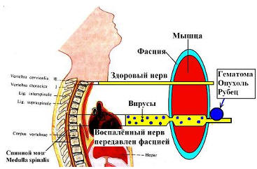 Рисунок 5 - 1. Причина возникновения радикулитов – поражение нерва вирусом, давление на него гематомой, опухолью, рубцом.