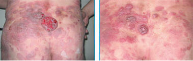 Множественные пятна, бляшки и опухолевые образования с элементами изъязвления на коже (до начала лечения)