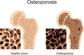 Остеопороз может начаться в детстве