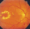 Препролиферативная ретинопатия