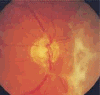 Пролиферативная ретинопатия