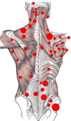 Рис. 1. Типичная локализация триггерных точек в скелетных мышцах