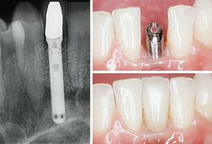 Зубные имплантаты 