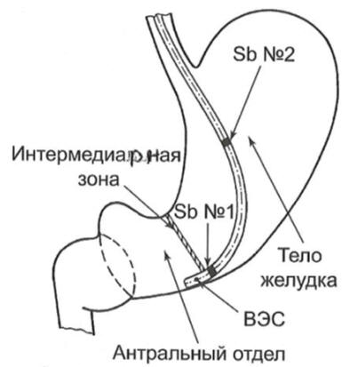 Рис.26 Схема расположения измерительных сурьмяных электродов рН-зонда с внутренним электродом сравнения (ВЭС) в желудке.