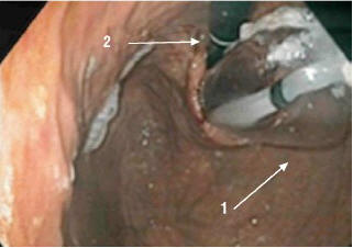 Рис. 6. ЭГДС. Ретропозиция из желудка – баллонный дилататор (1) и эндоскоп (2), проведенный через кардиоэзофагеальный переход (указаны стрелками) 
