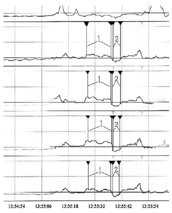 Рис. 2. Плато манометрической кривой (1) соответствует зоне давления покоя нижнего пищеводного сфинктера, релаксация НПС (2) в ответ на глоток