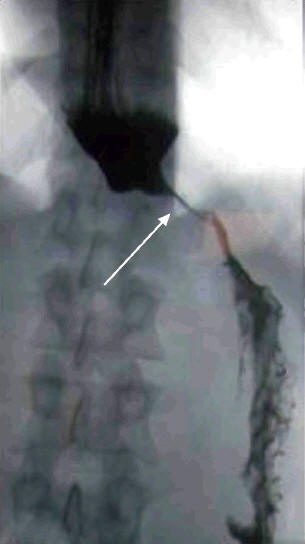 Рис. 2.   Рентгенограмма. Ахалазия кардии II стадии 