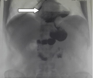 Рис. 1. Рецидив фиксированной аксиальной субтотальной ГПОД: стрелкой указано дно желудка, расположенное выше диафрагмы