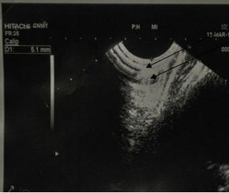 Рис. 2. Сканирование дистального отдела пищевода, на сканограмме представлены стенка пищевода, фундопликационная манжета с характерными складками слизистой желудка