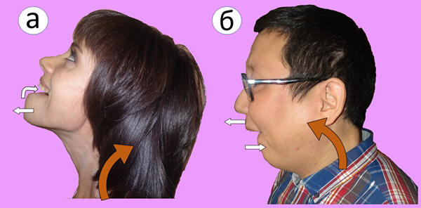 Рис. 5. Тренировка шейно-затылочных мышц и мышц гортани при помощи шейно-челюстных синкинезий. Обозначения: а – первая фаза упражнения, б – вторая фаза упражнения