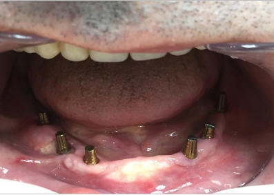 Рис.1. Вид полости рта пациента после имплантации.