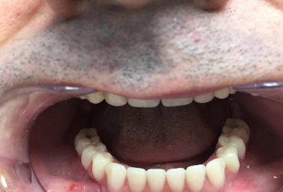 Рис.3. Вид полости рта после фиксации ортопедической конструкции.