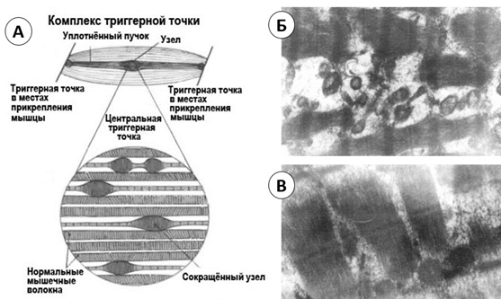 Рис. 25. Патоморфология триггерной точки