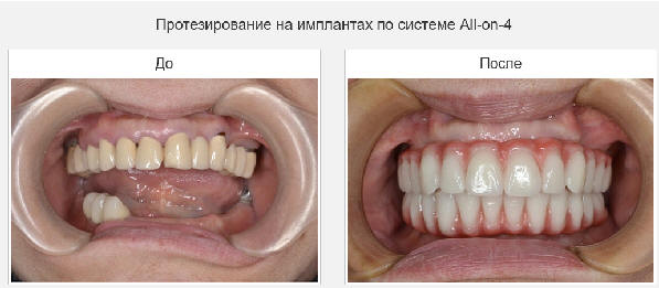 установка имплантация зубов