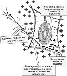 Рис. 34. Схематическая модель триггерной точки