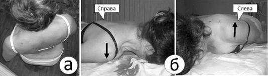 Рис. 48. Асимметрия взаиморасположения тазового и плечевого пояса при синдроме полной локомоторной синергии